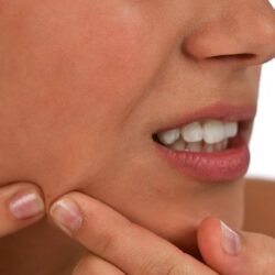 chcia con acne rompiendo granos infectados con toma laterial de la cara y fondo blanco