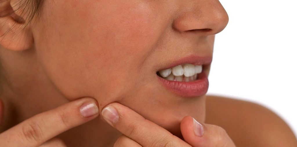 chcia con acne rompiendo granos infectados con toma laterial de la cara y fondo blanco