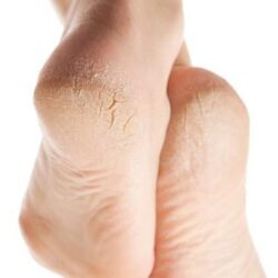 Grietas en los talones tratados con aceite de argán