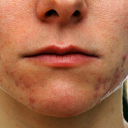 Tratamiento del acné con Aceite de Argán