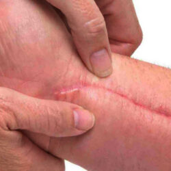 cicatriz antebrazo con fondo blanco