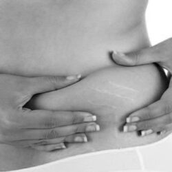 Estrias en lumbares de mujer en balnco y negro