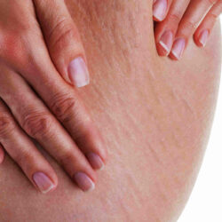 Estrias en muslo fondo blanco